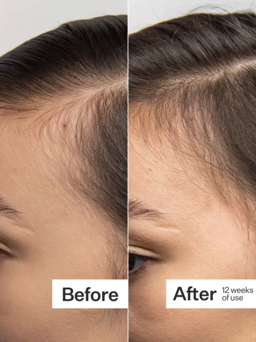 Act+Acre 0.25mm Scalp Dermaroller | MECCA